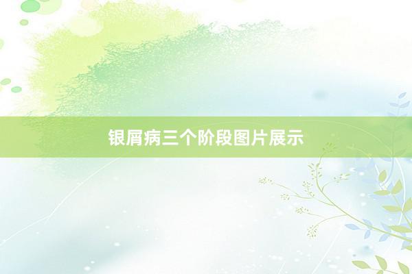 银屑病三个阶段图片展示